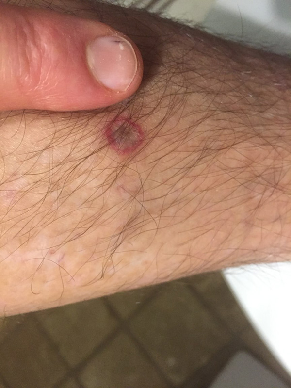 Karl Nelson was bit by a tick that had the deer tick virus.