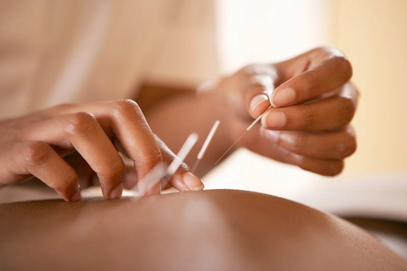 Acupuncture Jodie Treloar_A.jpg