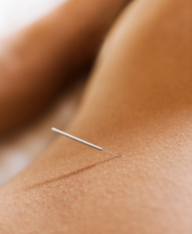 Acupuncture Jodie Treloar_B.jpg